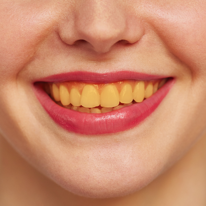 After - White teeth