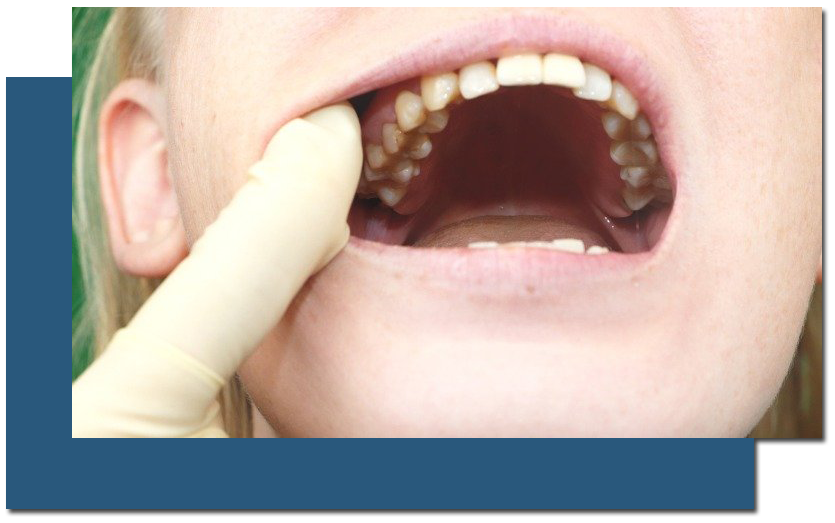 Oral Cancer Treatment