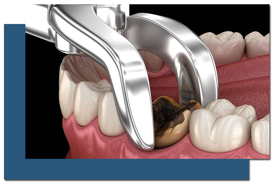 Surgical Extraction