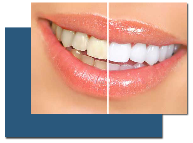 Professional Teeth Whitening