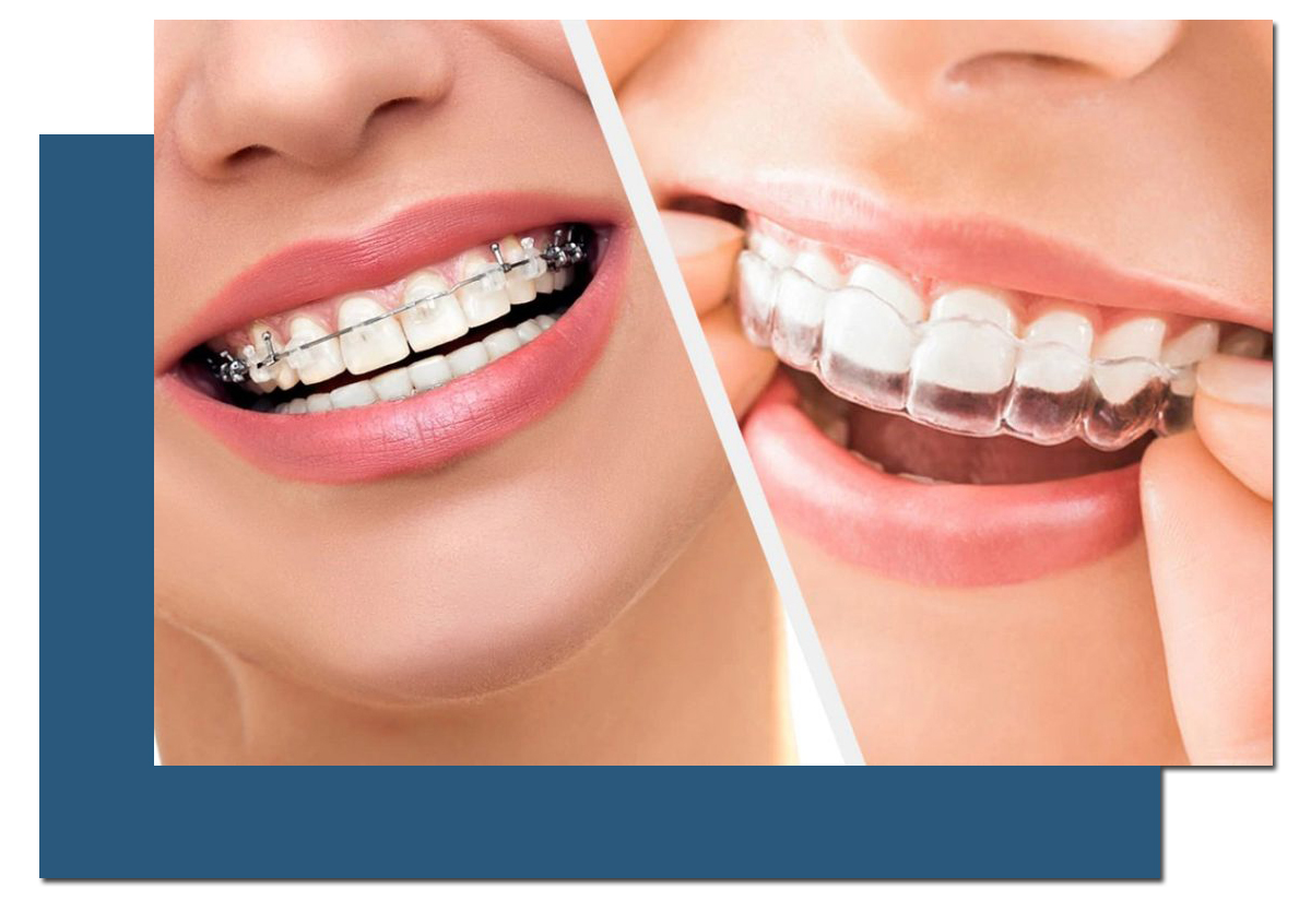 Braces and Clear Aligners