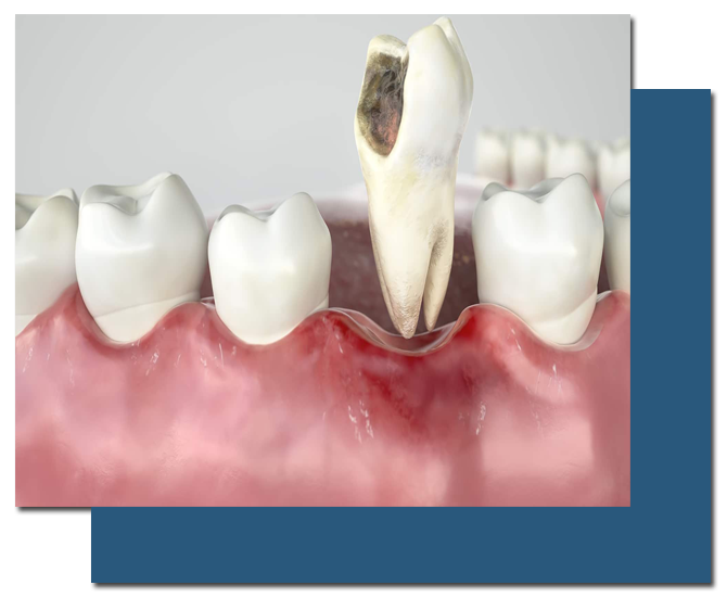 Dental Extraction