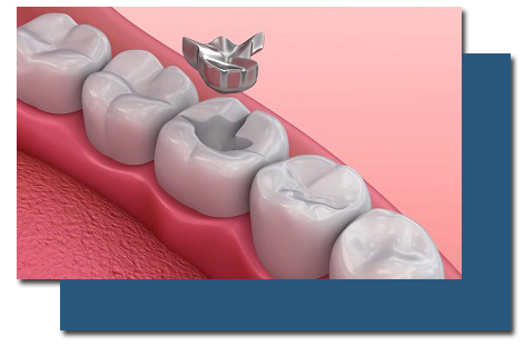 Tooth-Colored Dental Fillings