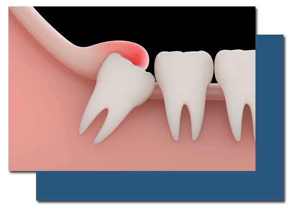 Wisdom Tooth Extraction